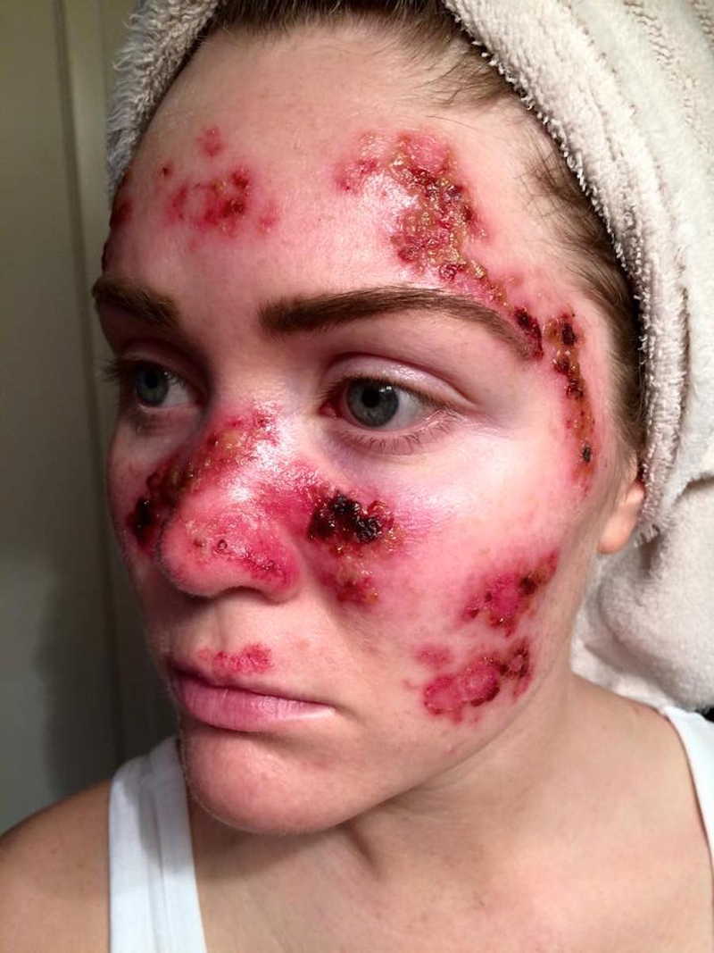 Illustration for article titled Woman's Shocking Selfie Shows What Skin Cancer From Tanning Looks Like